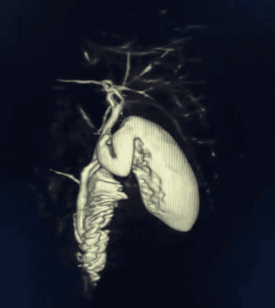 Ejemplo de reconstrucción 3D en resonancia